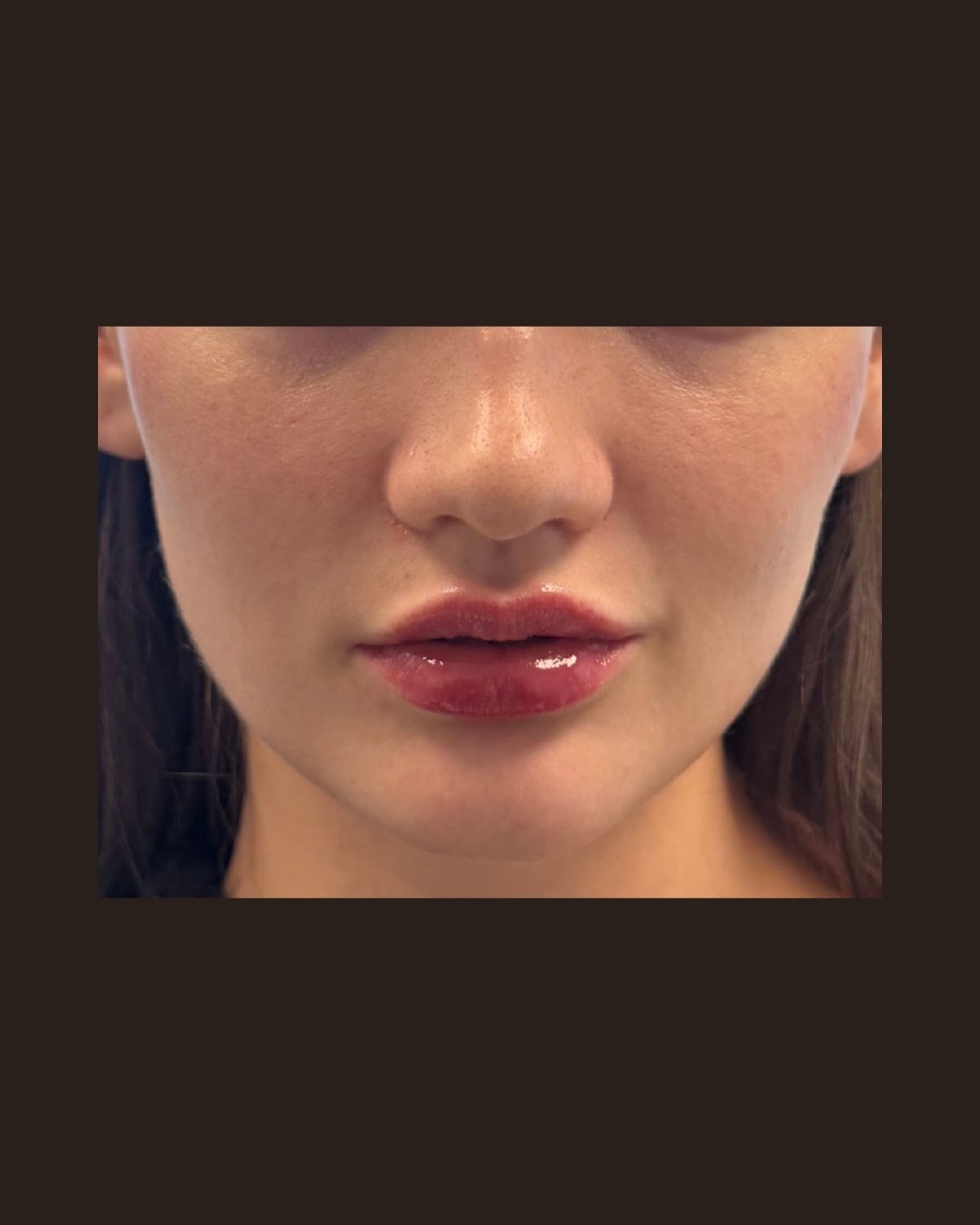 After lip filler showing balanced volume across the upper and lower lip