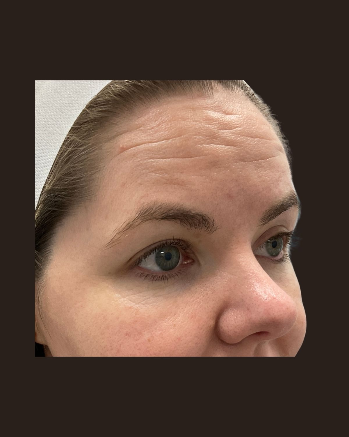 Before Morpheus8 showing facial skin laxity and uneven texture