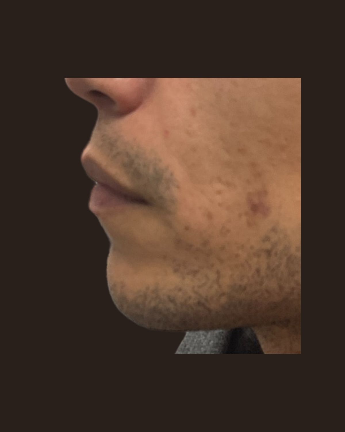 Before lip filler showing thin lips with limited definition