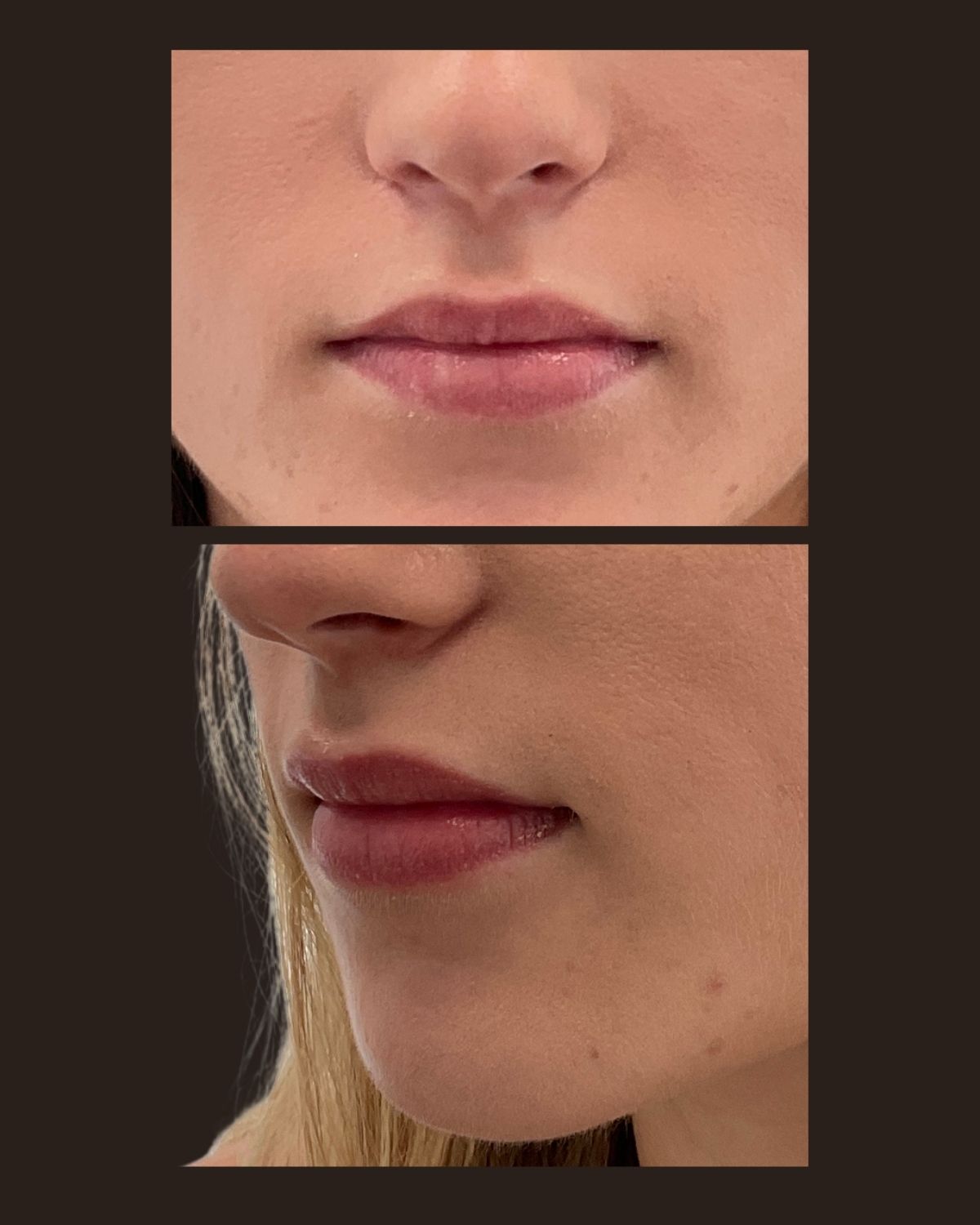 Before lip filler showing reduced lip volume and a soft vermilion border