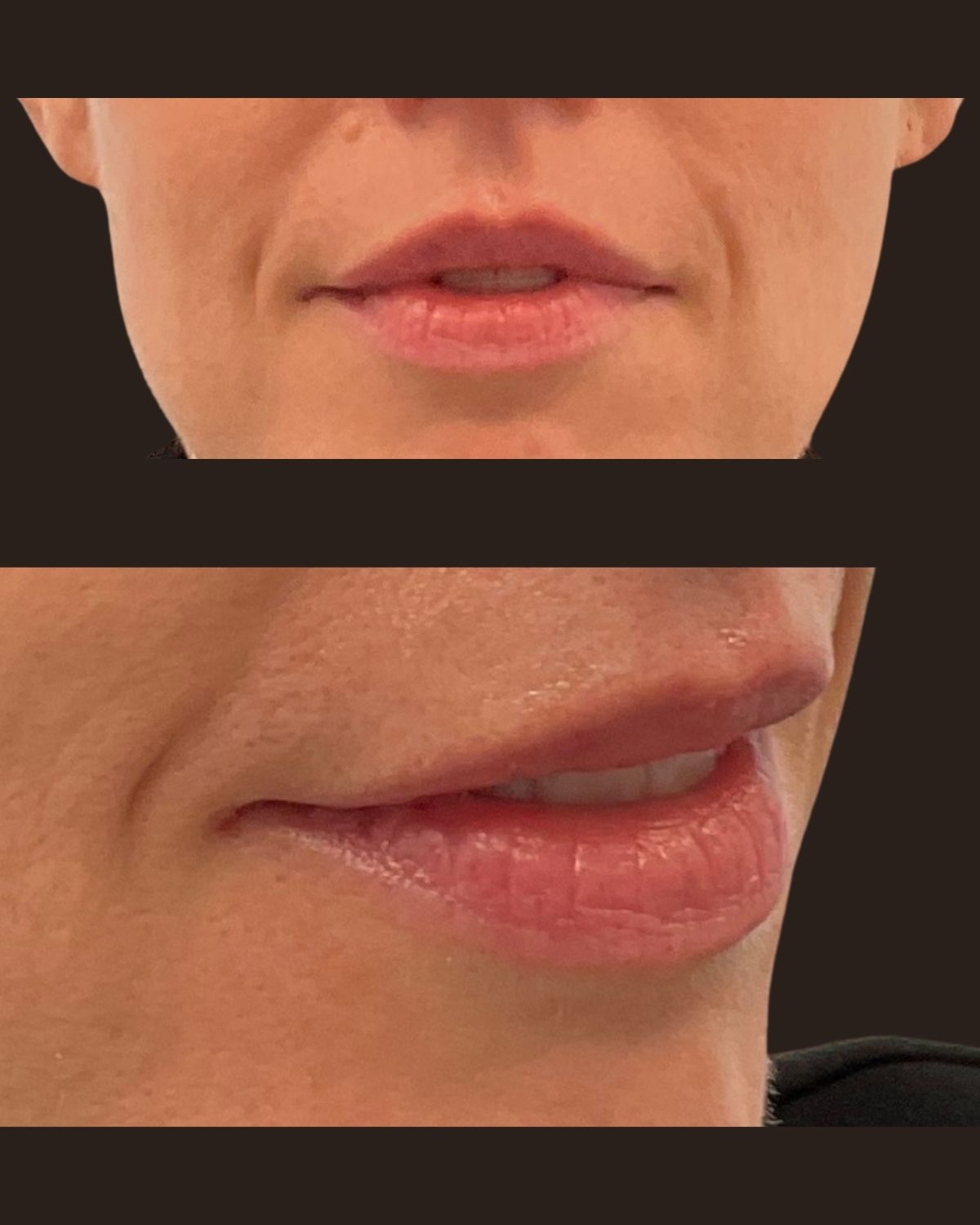 Before lip filler showing thin lips lacking projection