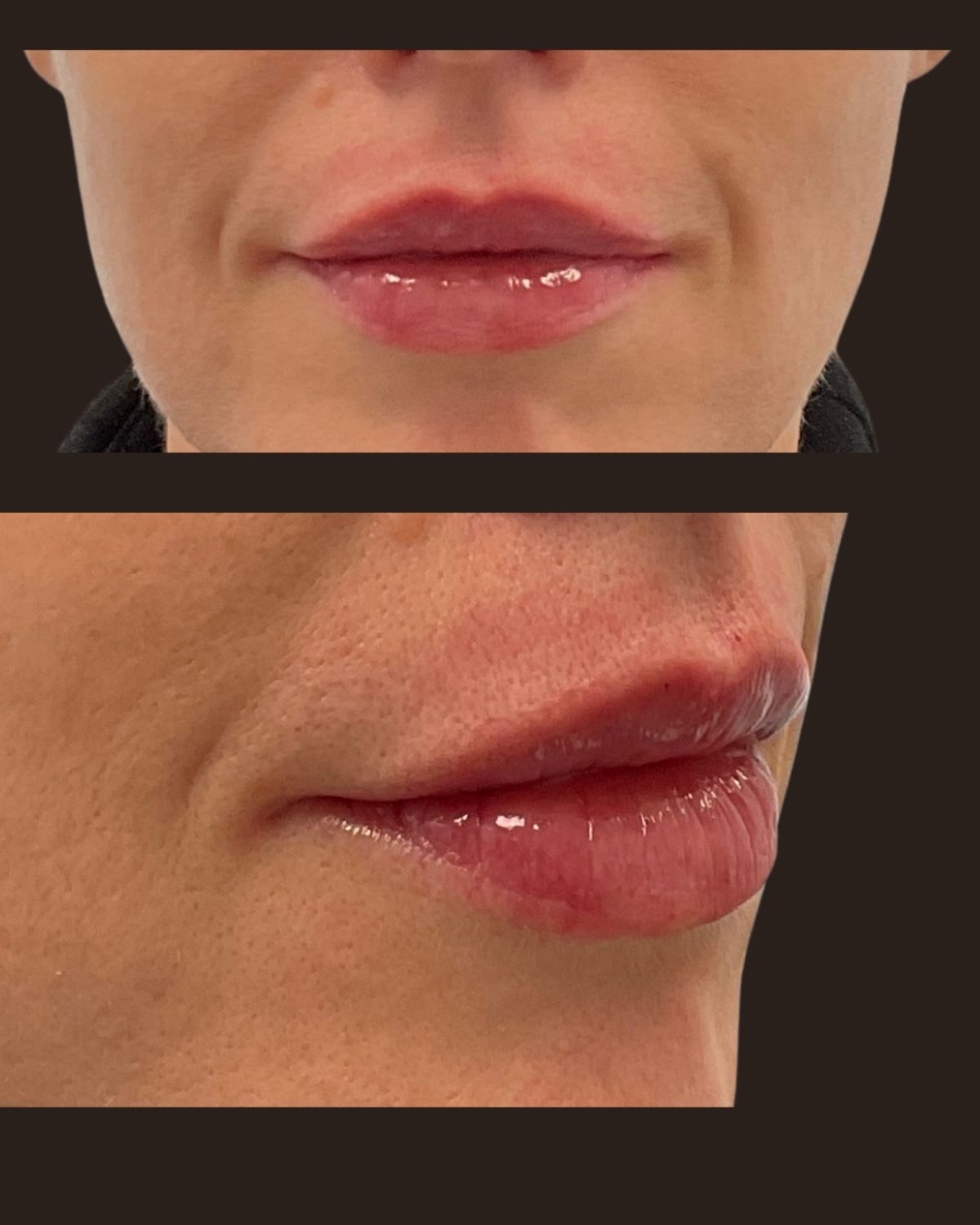 After lip filler showing natural augmentation with improved lip shape