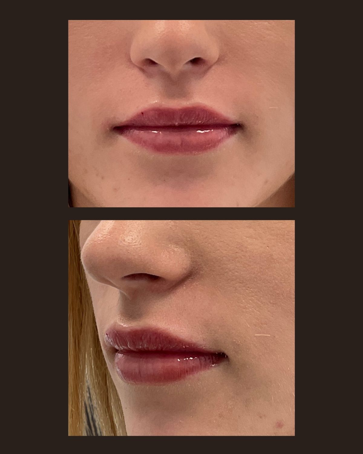 After lip filler showing subtle added volume and a defined lip border