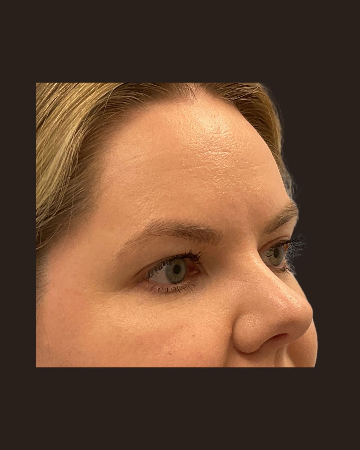 After a Morpheus8 series showing tighter skin and smoother facial texture