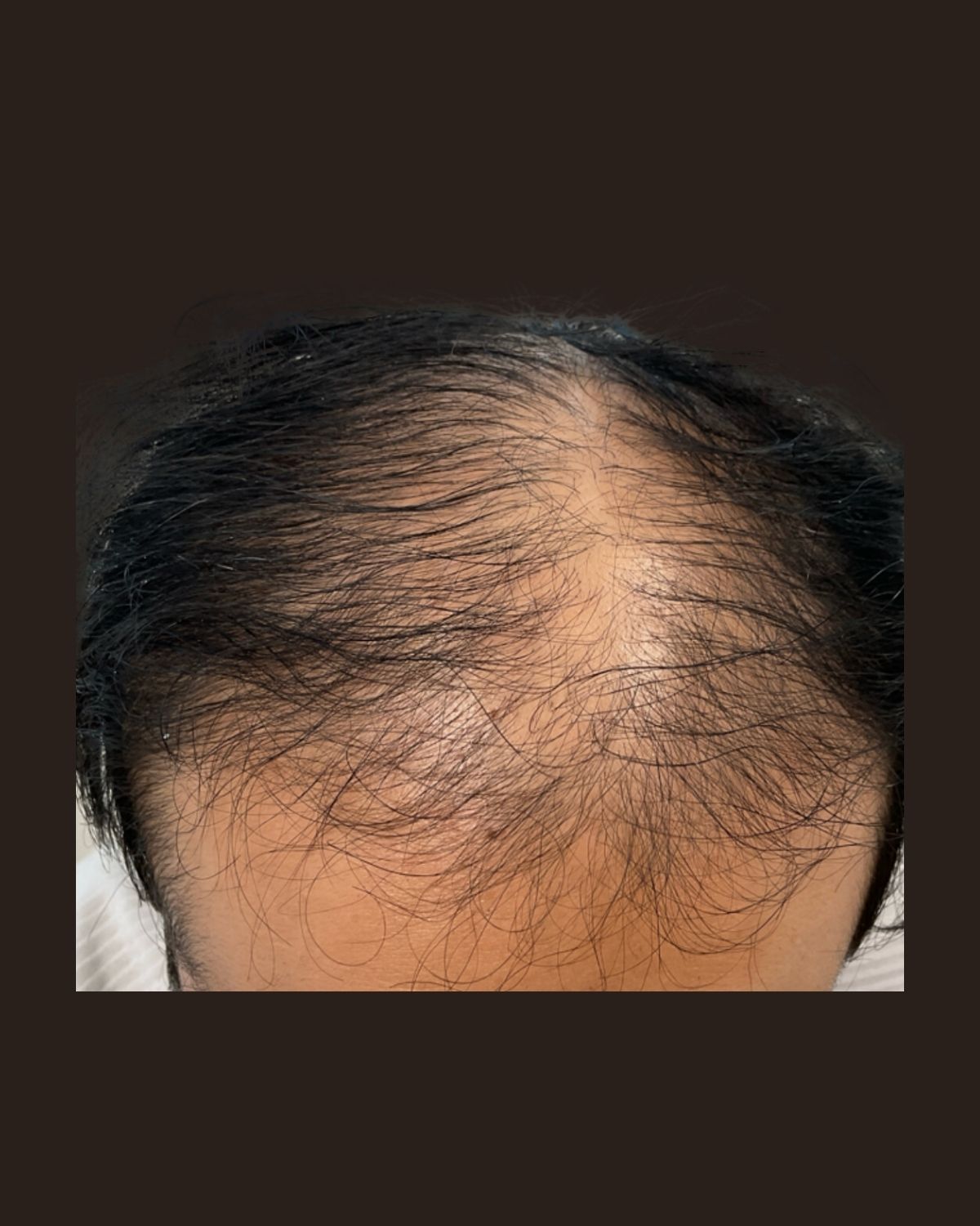 Before PRP hair restoration showing thinning hair and visible scalp