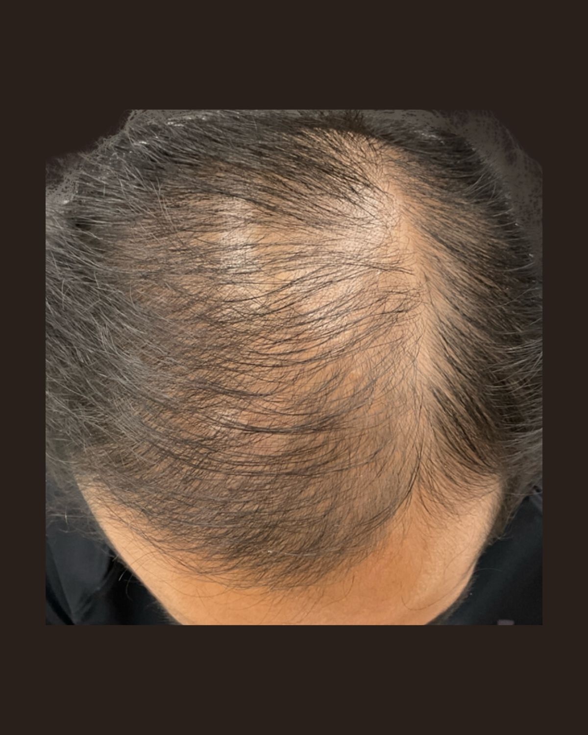 After 3 months of PRP hair restoration, taken before the third treatment, showing increased density across the treated scalp