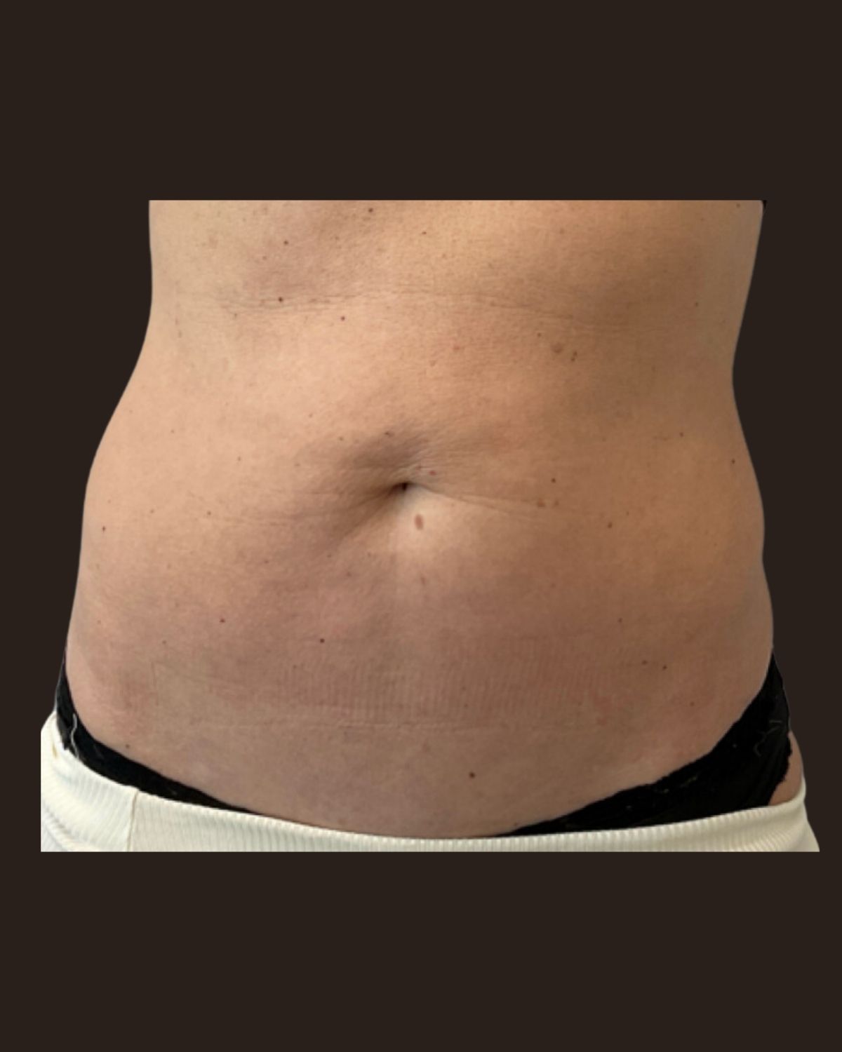 After a Morpheus8 Body series showing firmer skin and improved contour of the abdomen