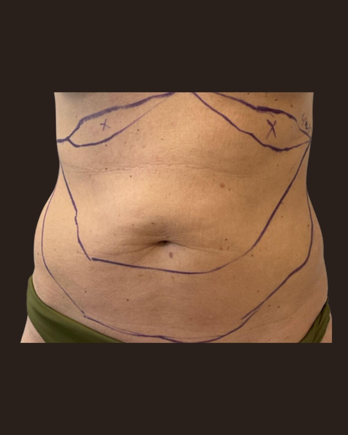 Before Morpheus8 Body showing skin laxity and uneven texture across the abdomen