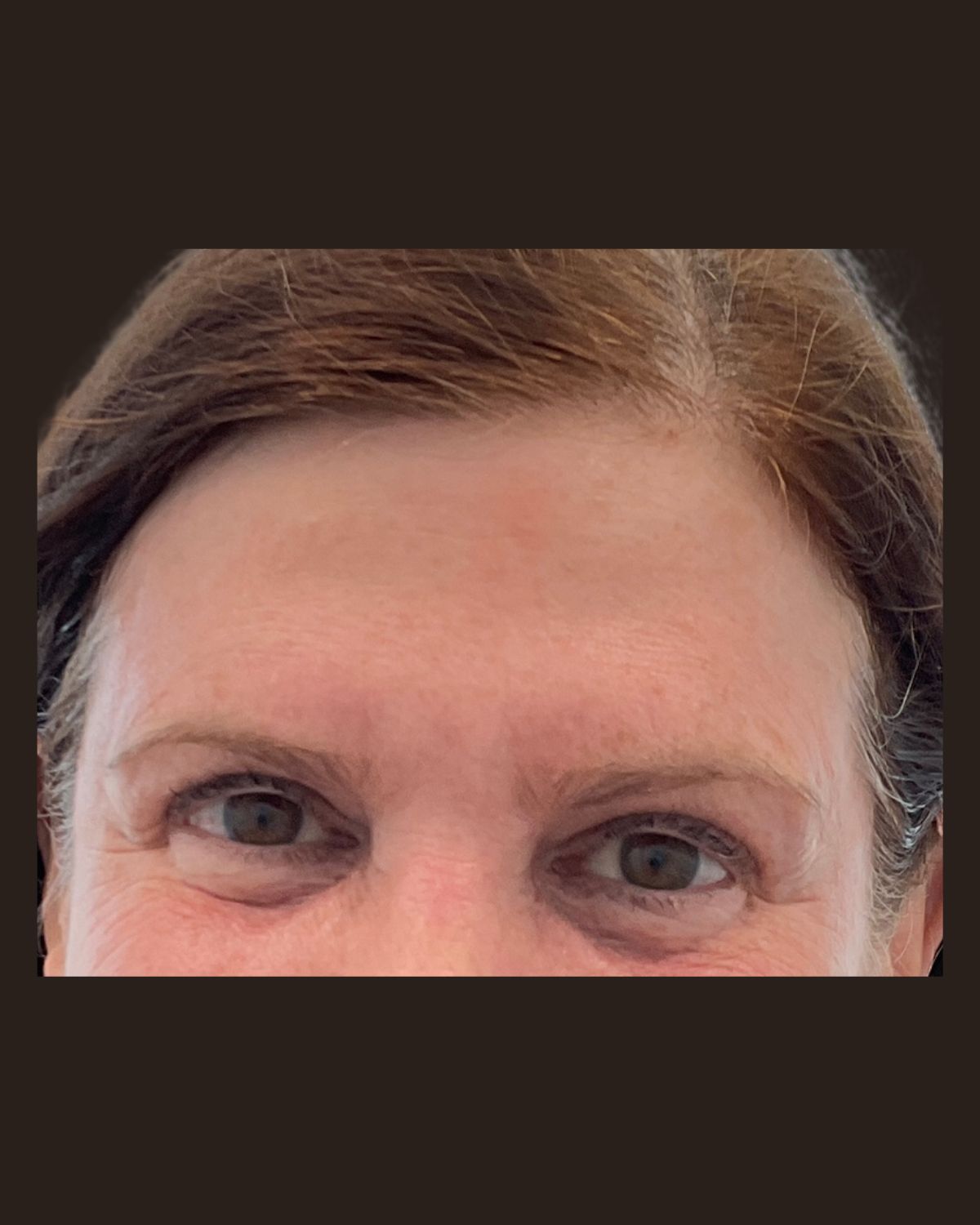 After LaseMD Ultra resurfacing showing reduced sun damage and a more even skin tone