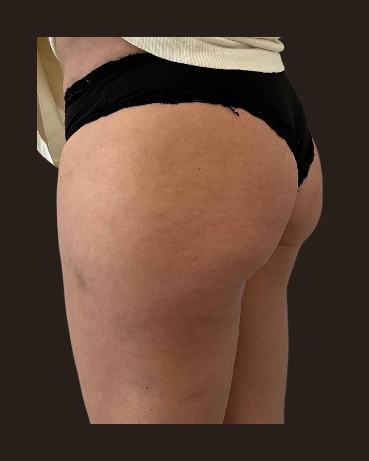 After a Morpheus8 Body series showing smoother skin texture and tighter contour of the buttock