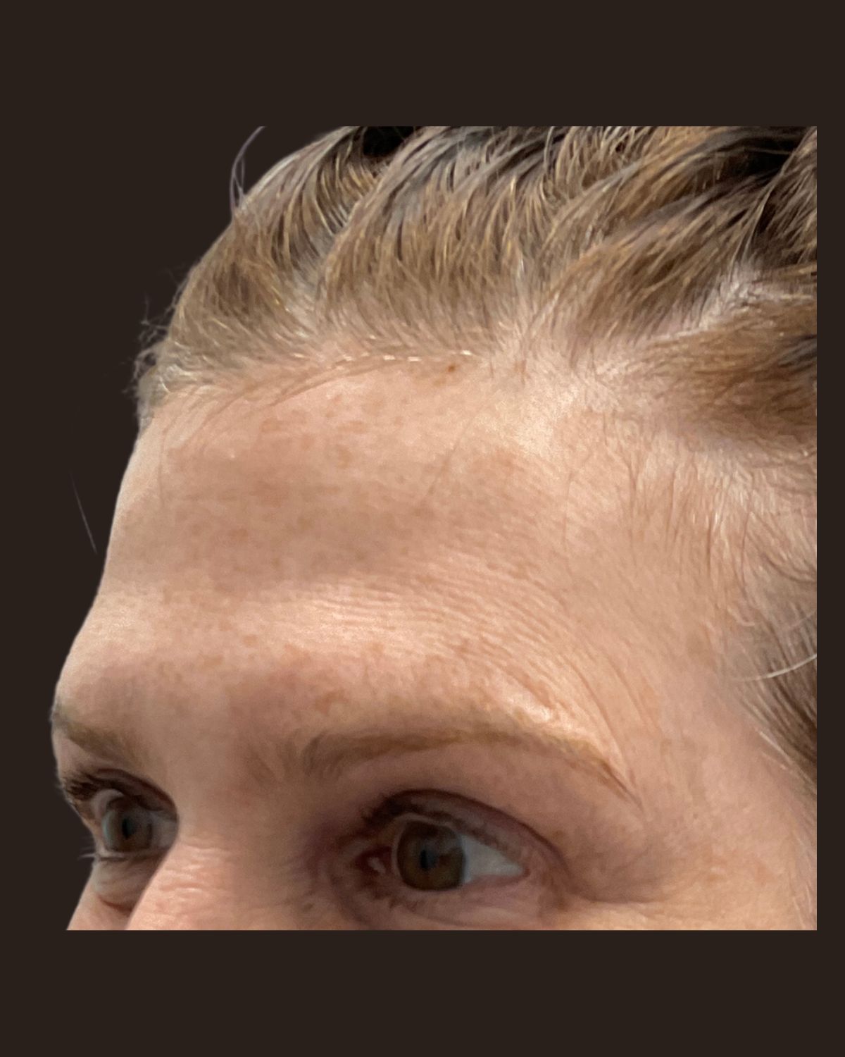 Before LaseMD Ultra showing sun damage and uneven pigment across the face