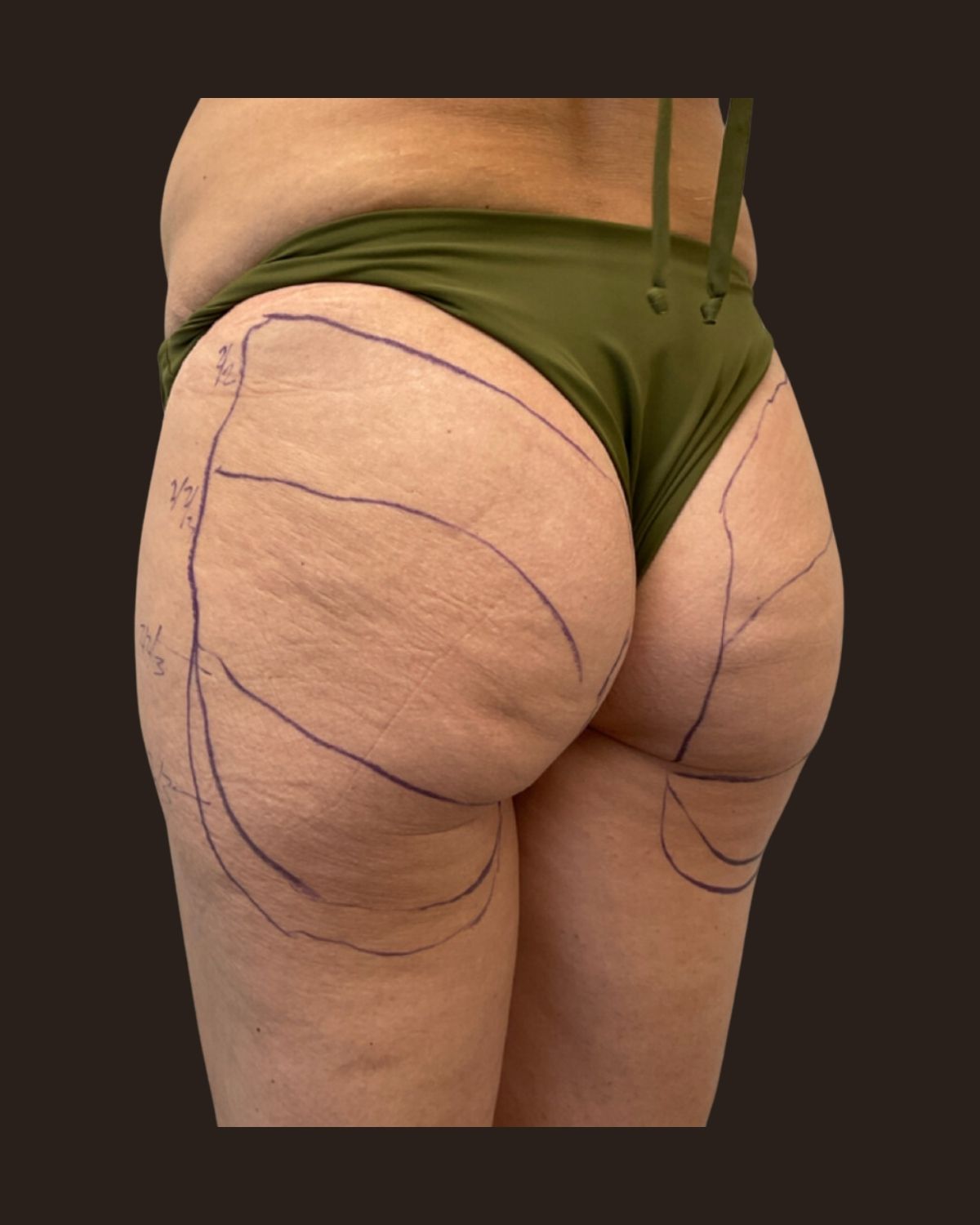 Before Morpheus8 Body showing skin laxity and dimpling across the buttock