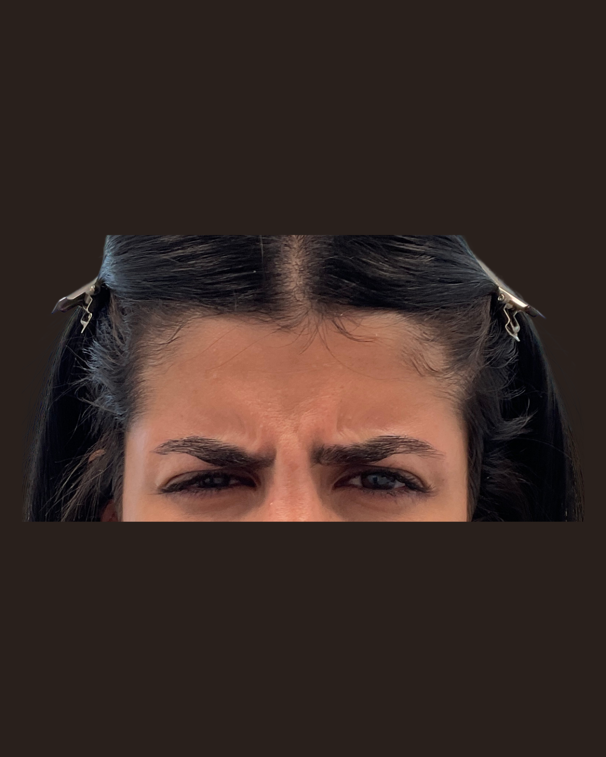 Before Botox for the 11s showing deep vertical frown lines between the brows