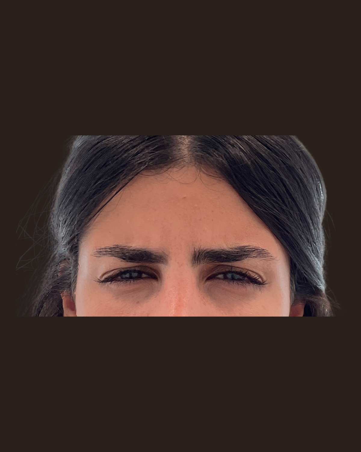 Two weeks after Botox for the 11s showing softened frown lines between the brows