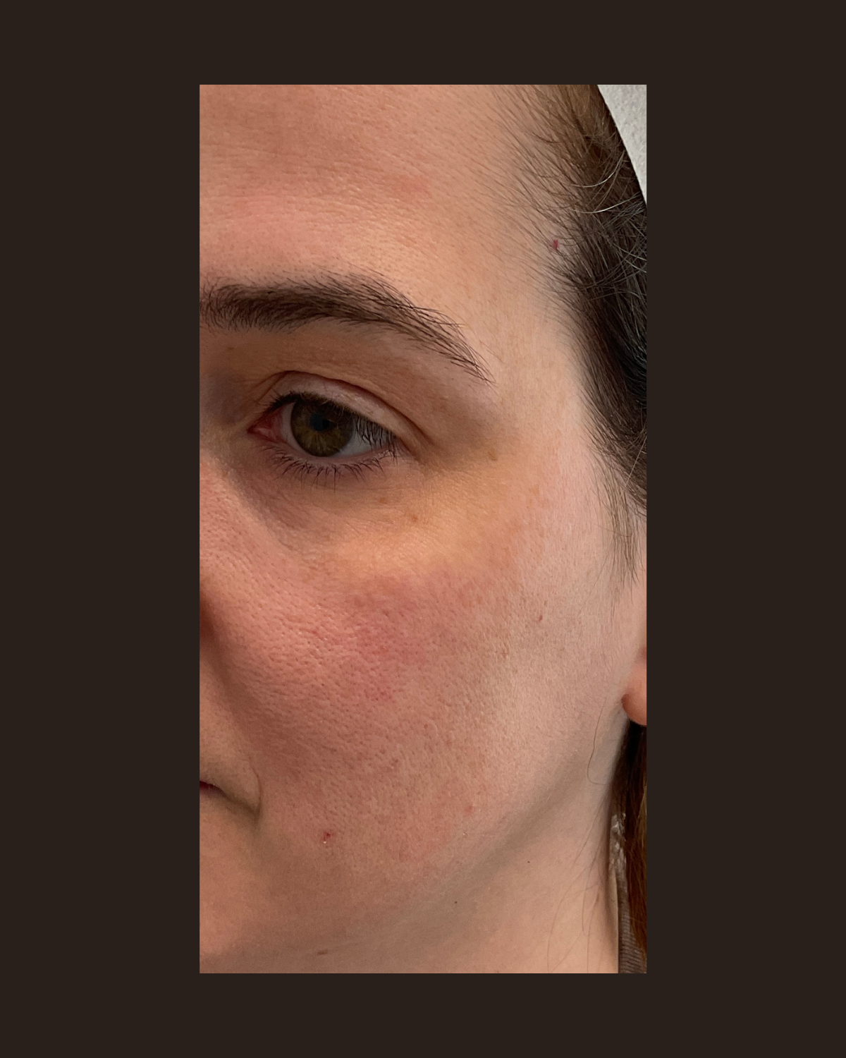 Before the Glowup package showing uneven skin texture and tone across the cheek and under-eye area