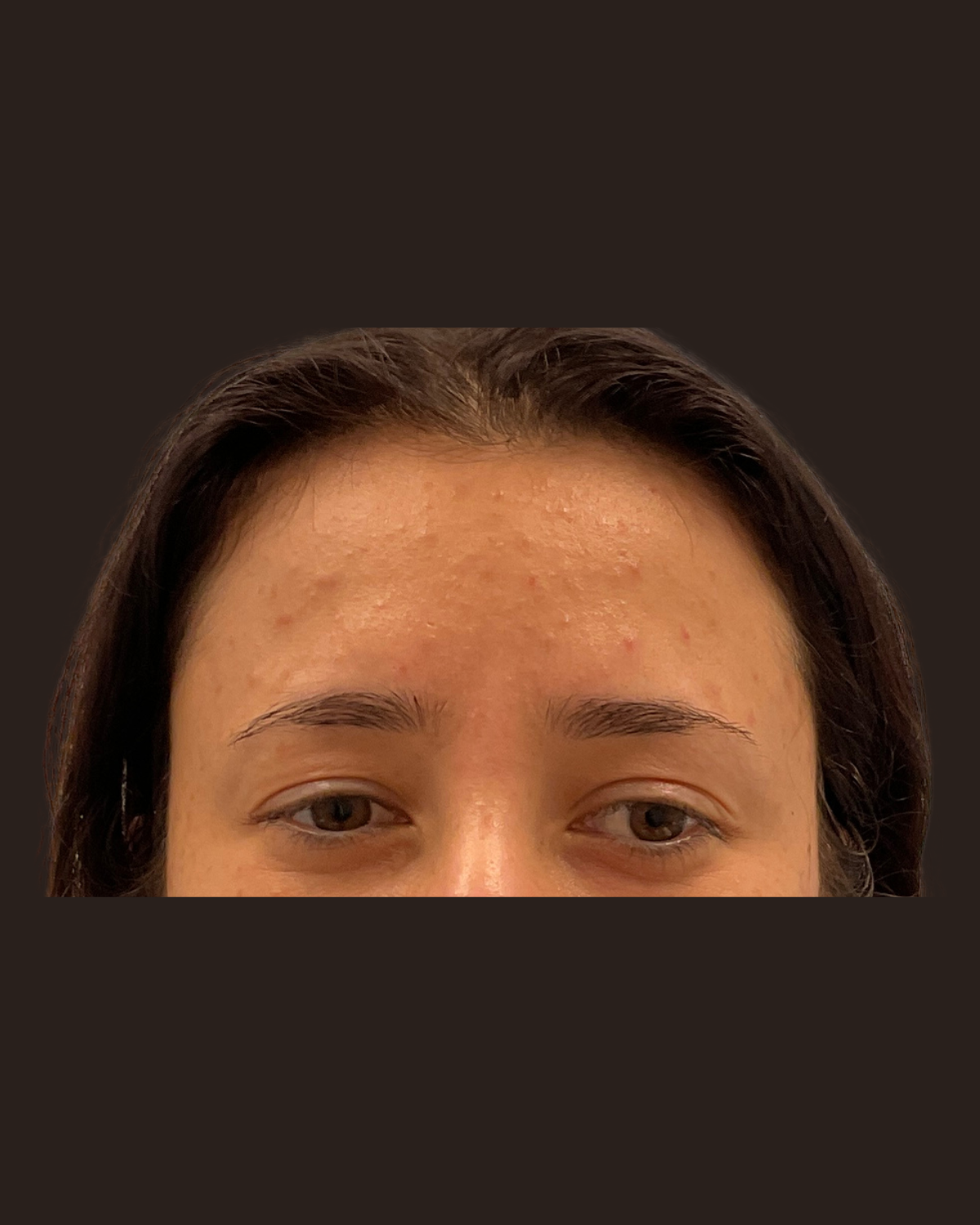 Two weeks after Botox for the 11s showing a smoother area between the brows