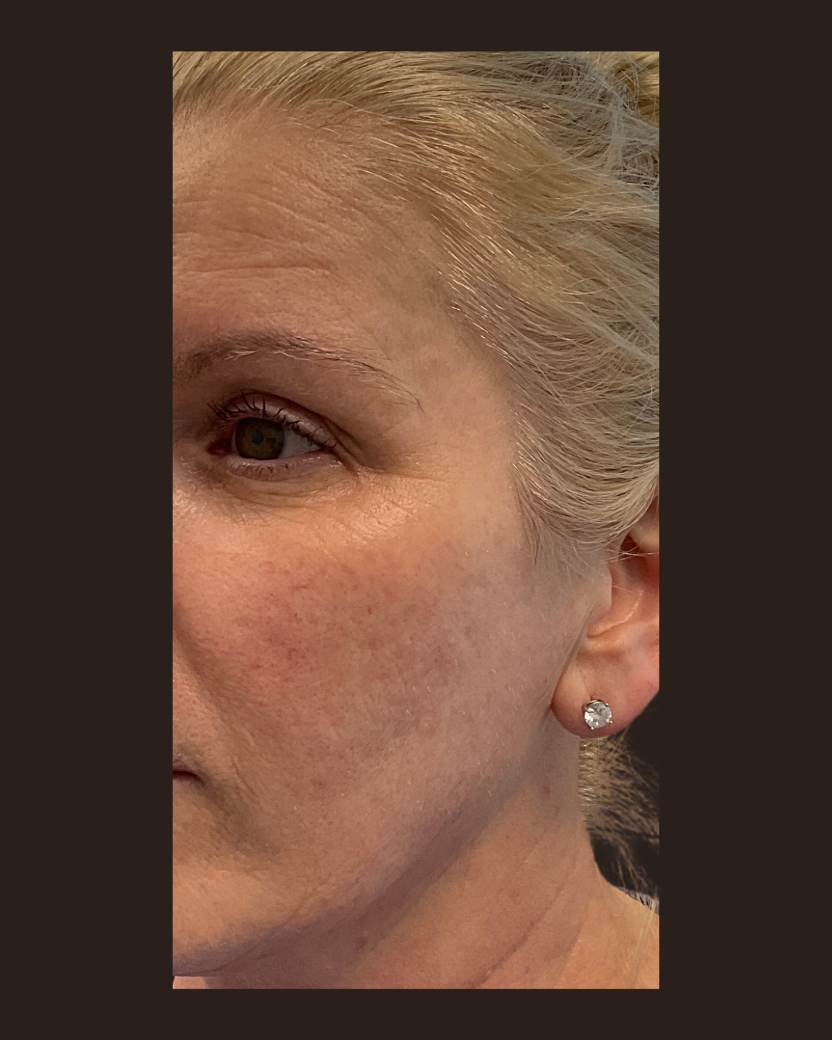 Before the Glowup package showing fine lines and uneven texture around the eye and cheek
