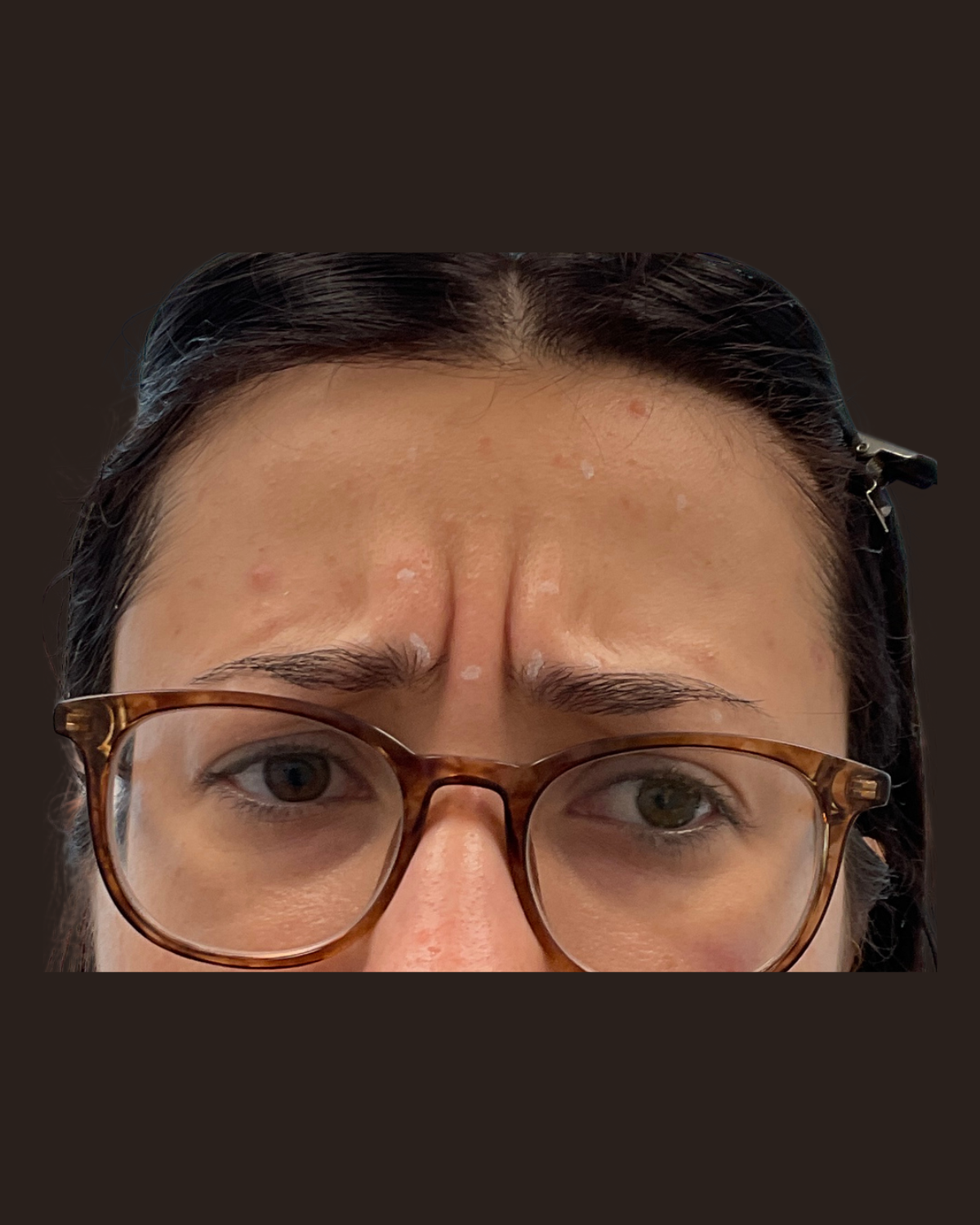 Before Botox for the 11s showing pronounced frown lines between the brows while frowning
