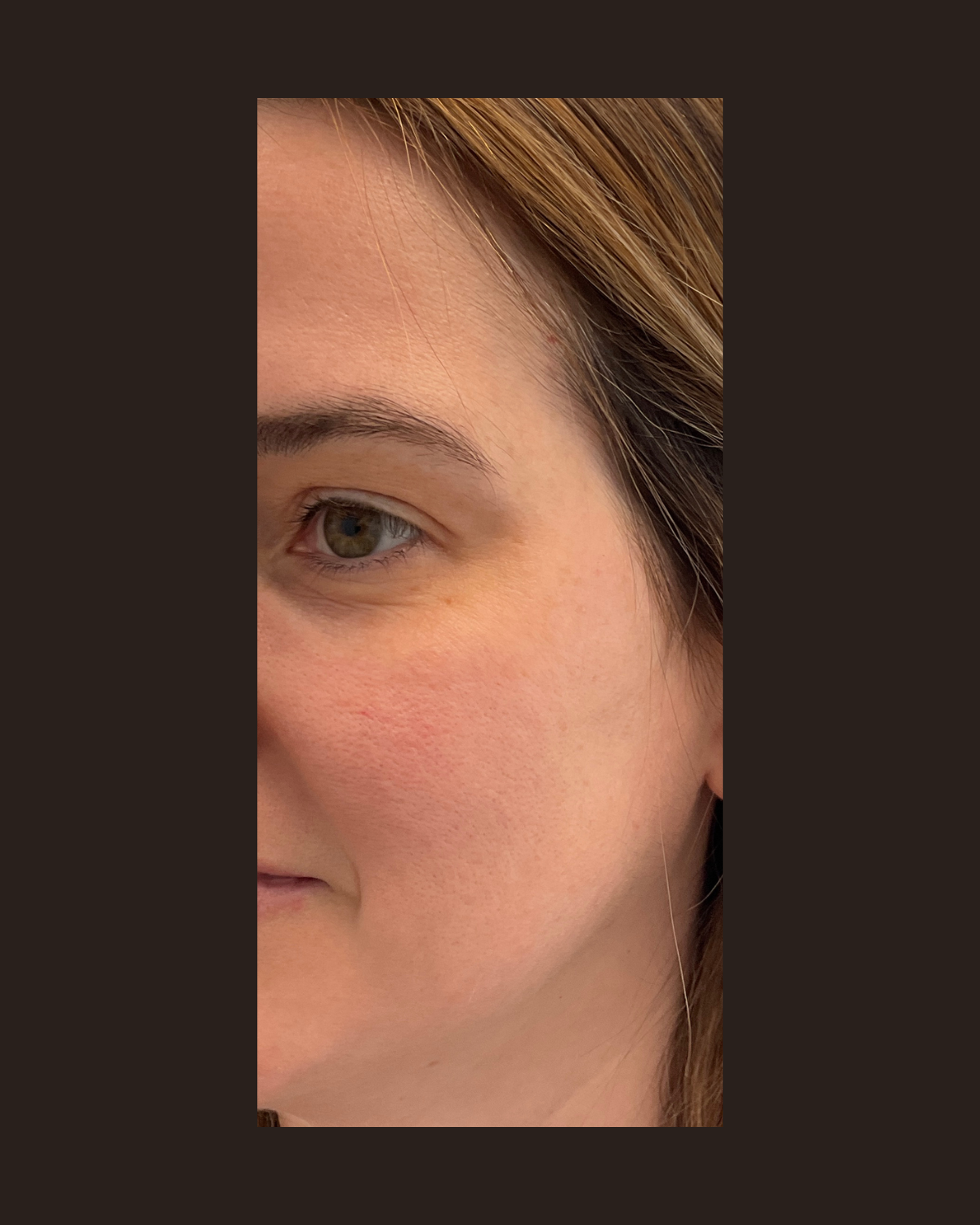 Four weeks after the Glowup package (Morpheus8, microneedling, LaseMD Ultra and PRP) showing smoother, more even skin across the cheek and under-eye area