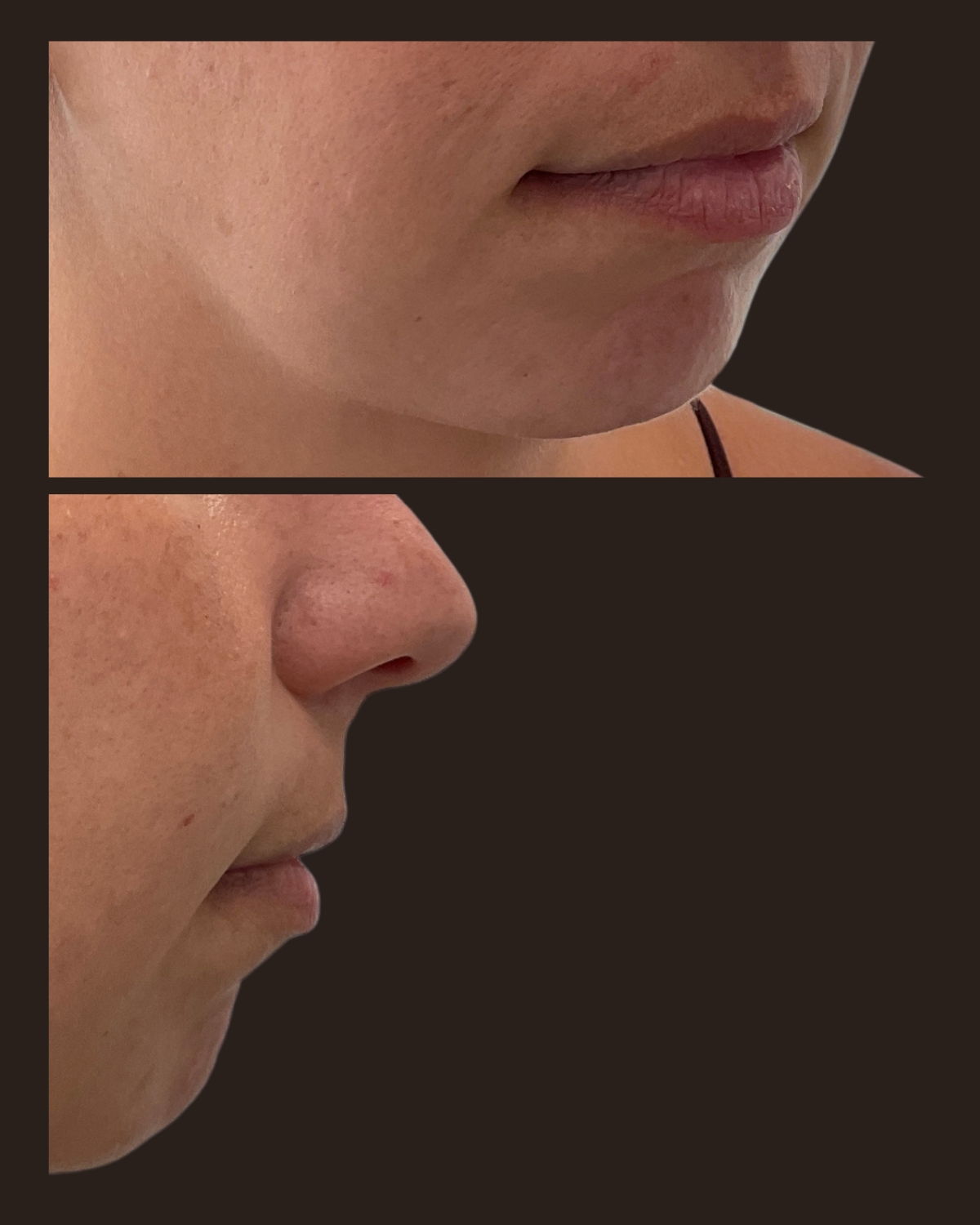 Before chin filler, oblique and side-profile views showing limited chin projection