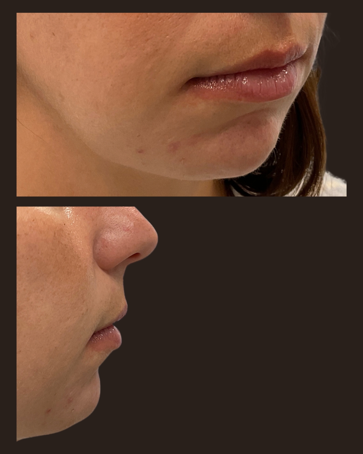 After 2 cc of Juvéderm Volux XC to the chin, oblique and side-profile views showing greater chin projection and a more defined lower-face profile