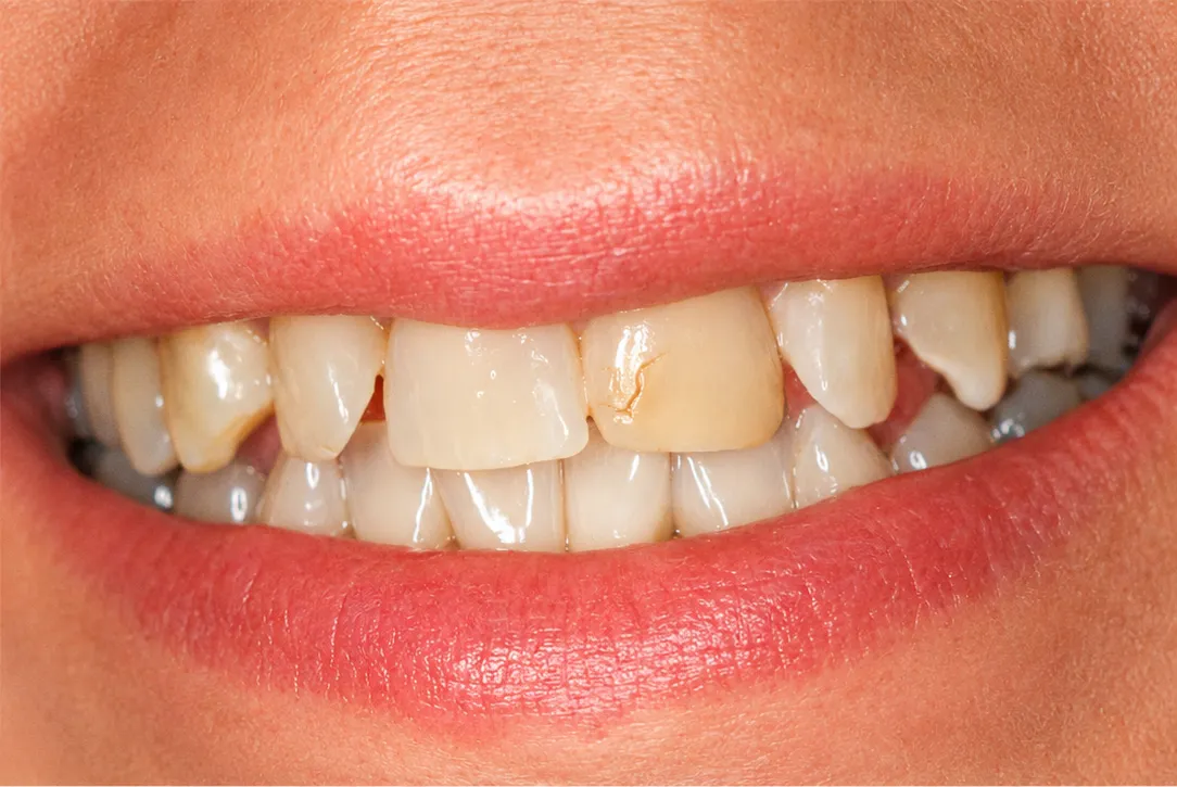 Before porcelain veneers — Nova Dental Care of Chantilly