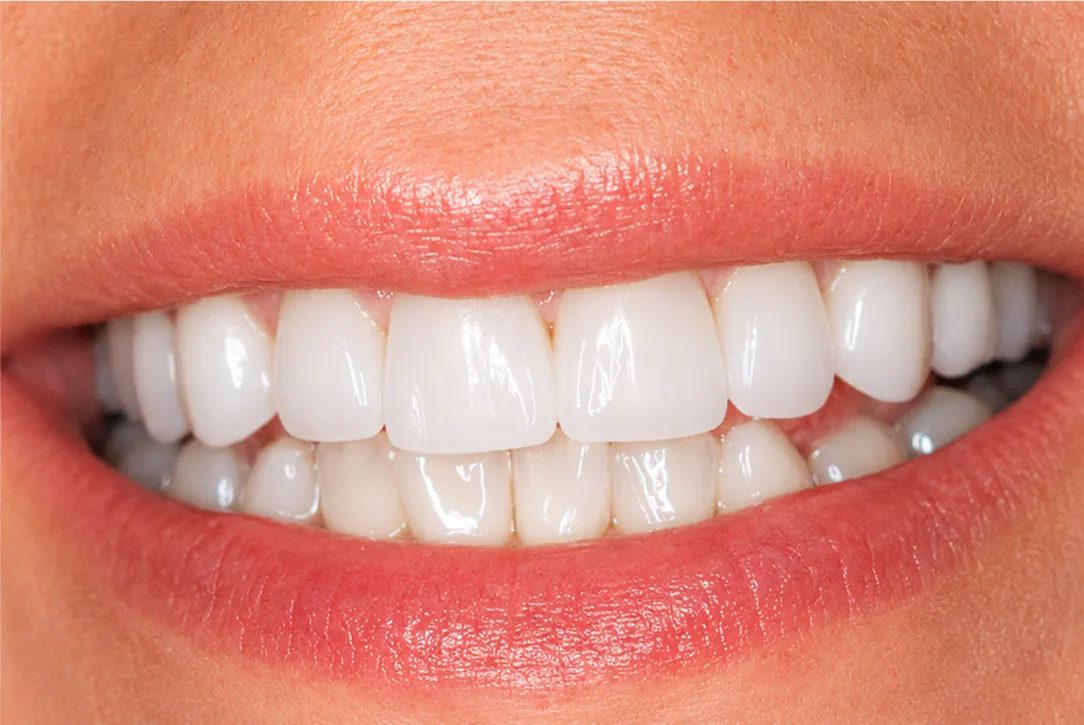After porcelain veneers — Nova Dental Care of Chantilly