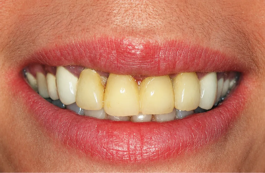 Before cosmetic dental treatment — Nova Dental Care of Chantilly