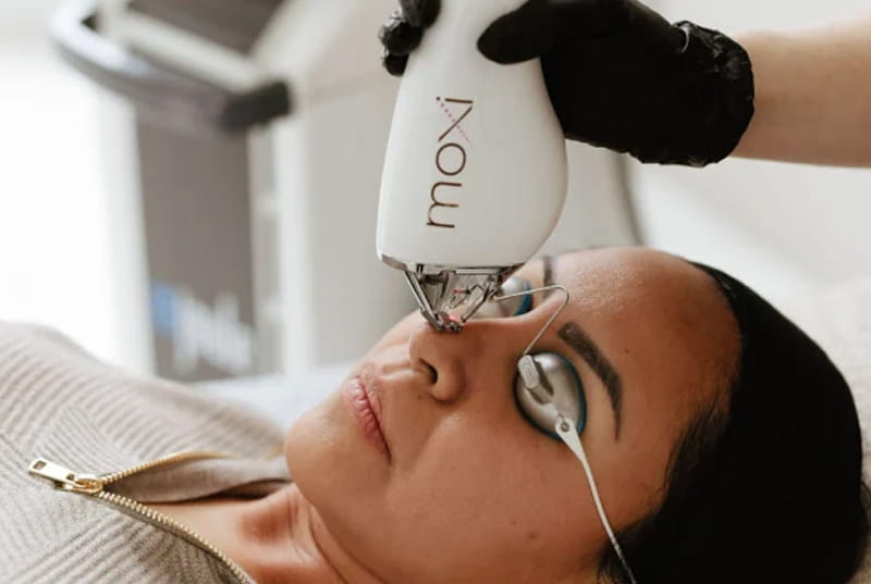 MOXI fractional laser for gentle skin rejuvenation in Jacksonville, Florida