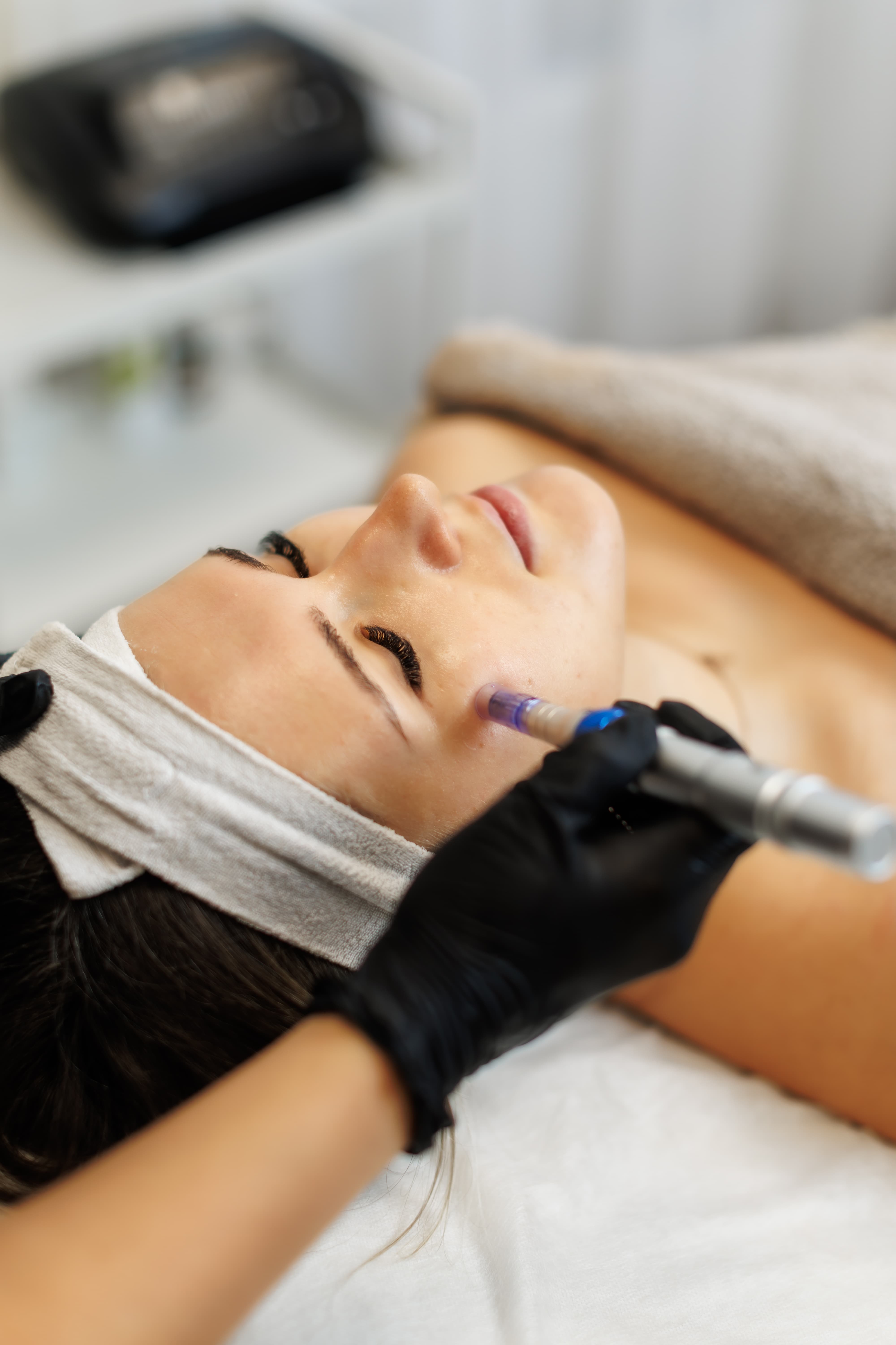Smoother skin texture after a course of microneedling treatments