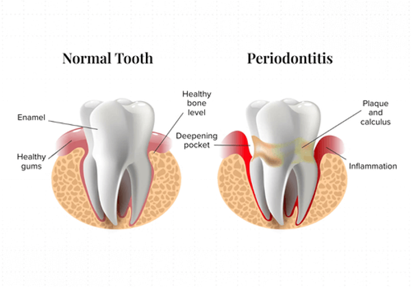 Gum Disease Diagram