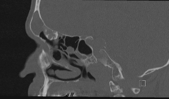 Sagittal CT scan of the nasal and maxillary sinus, showing visible bone and soft tissue structures.