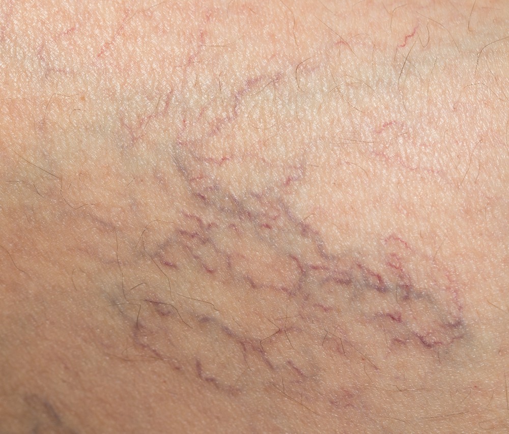skin vein