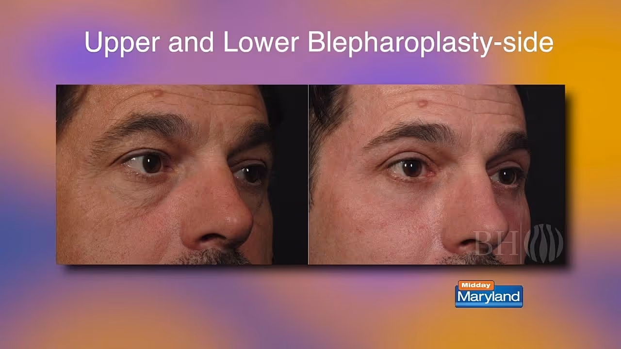 A side-by-side comparison of two male faces showing the results of upper and lower blepharoplasty. The left image displays a before scenario with noticeable eyelid sagging, while the right image shows a after surgery with a firmer eye appearance.