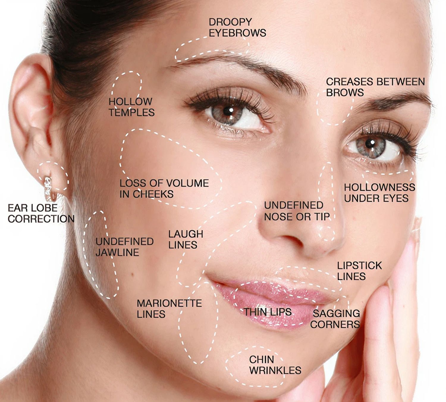 A close-up image of a woman's face with various annotations highlighting facial features such as 'droopy eyebrows', 'hollow temples', 'loss of volume in cheeks', 'undefined jawline', 'thin lips', and 'sagging corners'.