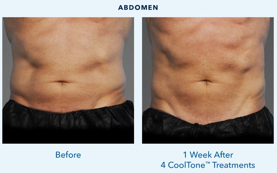 A side-by-side comparison of two male abdominal areas labeled 'Before' on the left and '1 Week After 4 CoolTone™ Treatments' on the right, showcasing the appearance of the skin and muscle tone.