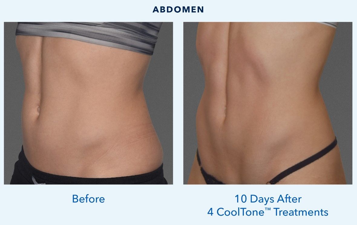 A side-by-side comparison of a female abdomen labeled 'Before' on the left and '10 Days After 4 CoolTone™ Treatments' on the right, showing differences in muscle tone and skin appearance.