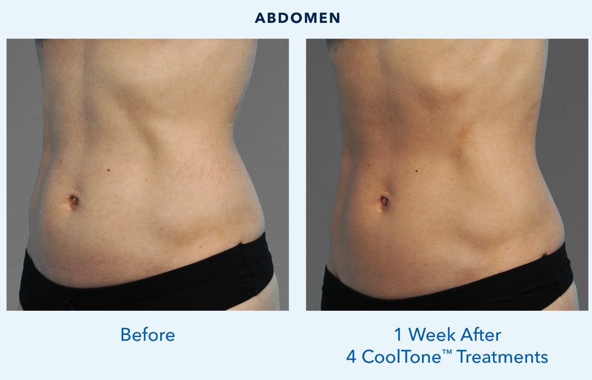 A comparison of two images showing the abdomen of a person. The left image is labeled 'Before' and the right image is labeled '1 Week After 4 CoolTone™ Treatments'.