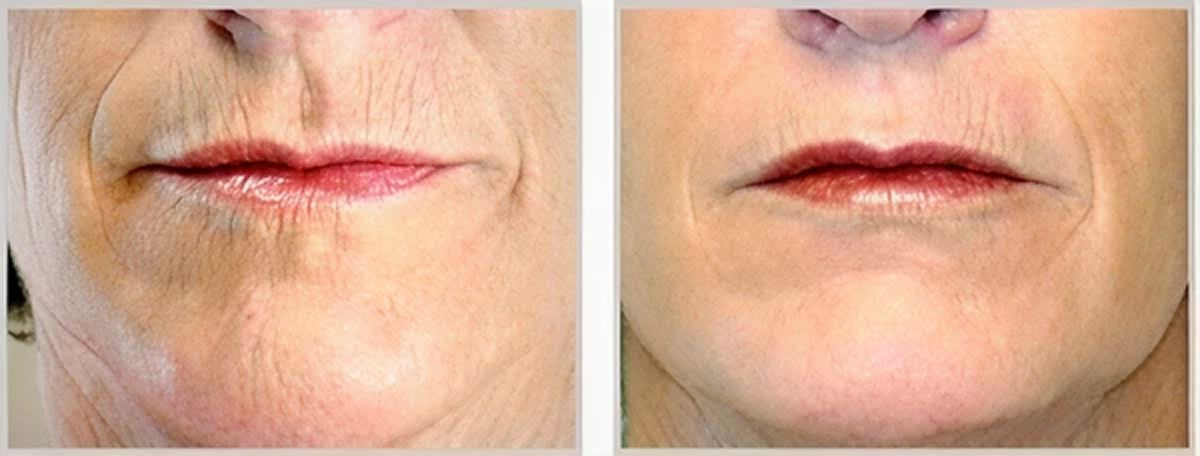 A comparison of two close-up photographs of a person's mouth area, showing differences in skin texture and wrinkle appearance.