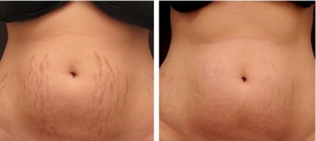 A comparison image showing two female abdomens: the left side displays visible stretch marks in a reddish hue, while the right side shows smoother skin with significantly reduced visibility of the stretch marks.