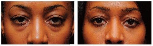 before after eyelid surgey black woman