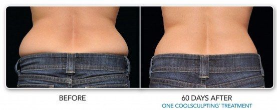 before after belly buldge