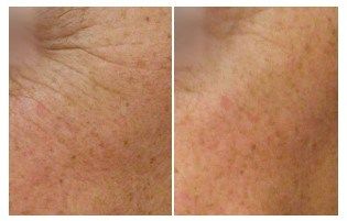 plastic surgery featured image for blog for Belcara Health in Baltimore, MD