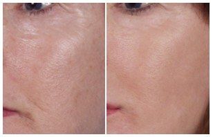 plastic surgery featured image for blog for Belcara Health in Baltimore, MD