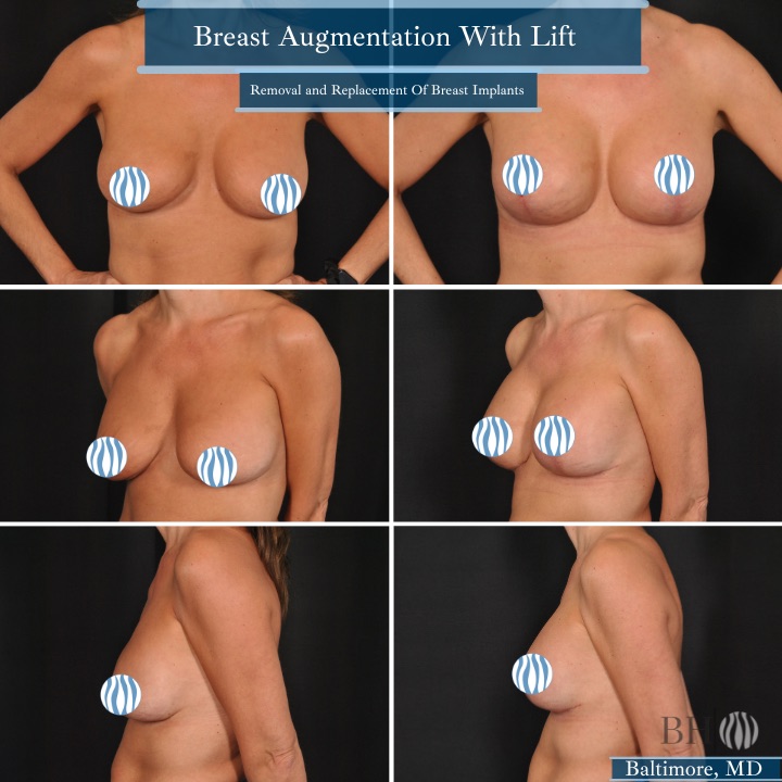 breast_augmentation
