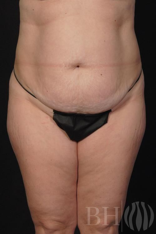 Front view of a person's midsection and upper thighs showing excess abdominal skin and body contour, wearing a black bikini bottom, with a 'BH' watermark logo in the lower right corner.