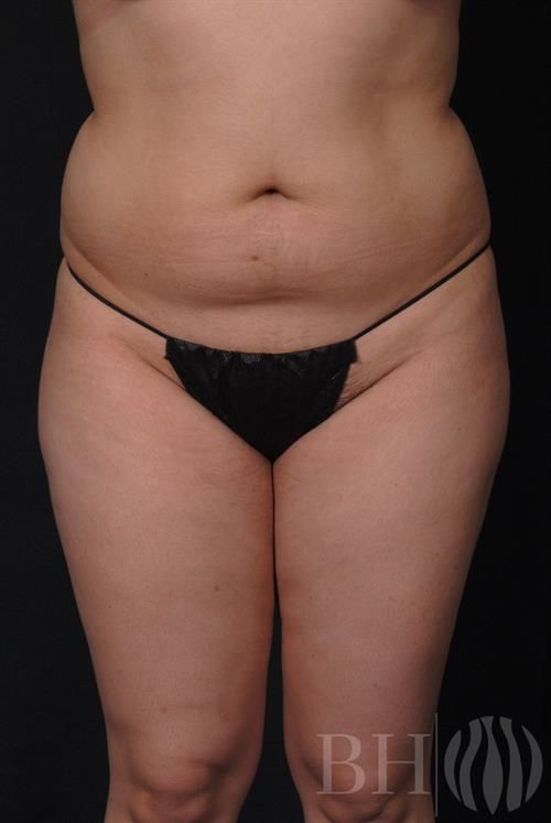 Front view of a person's torso and upper legs wearing black bikini underwear, used as a clinical before-and-after reference photo for a body contouring procedure, with the 'BH' logo watermark in the lower right corner.