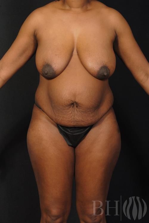 Front-view clinical photo of a woman's torso showing breasts before a breast augmentation and lift procedure, with the 'BH' logo watermark in the lower right corner.