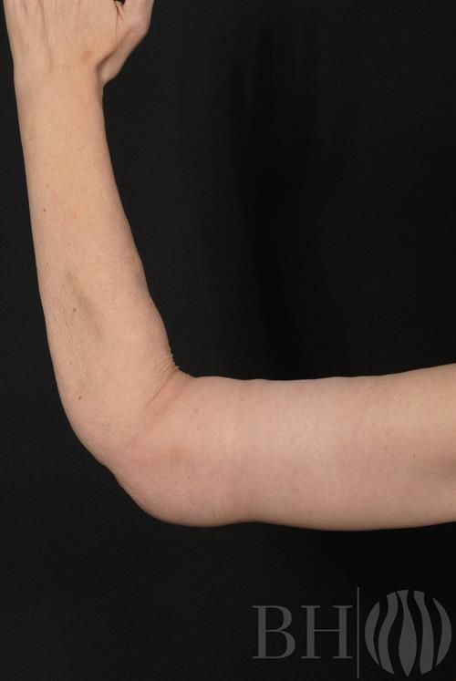 A close-up side view of a person's bent arm showing the upper arm, elbow, and forearm, with a visible scar along the inner arm, against a dark background. A 'BH' logo watermark with a flame-like icon is visible in the bottom right corner.