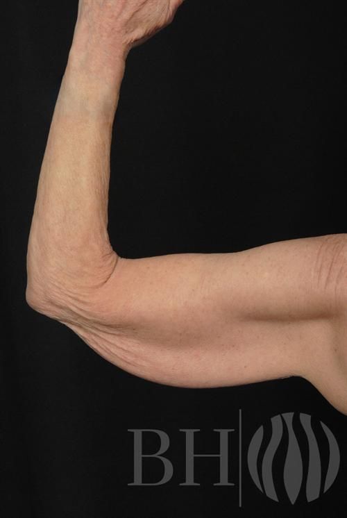 A close-up photo of a mature person's bent arm showing the upper arm and bicep area with loose skin, accompanied by the 'BH' logo watermark with a flame-like icon in the lower right corner.